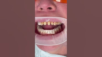 Dental crowns on front teeth | dental crown procedure front tooth | porcelain veneers | Dr. Yazdan