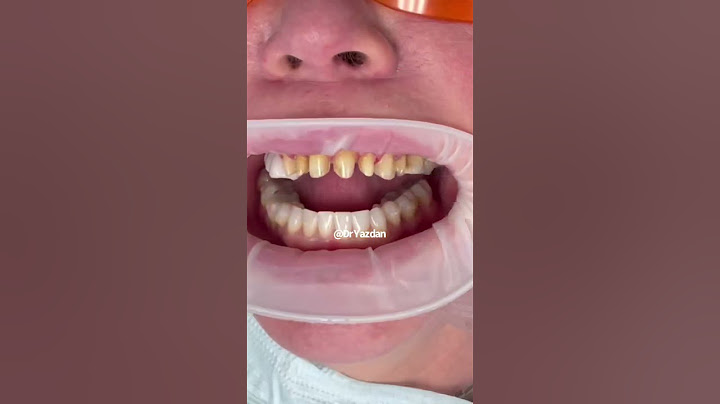 Dental crowns on front teeth | dental crown procedure front tooth | porcelain veneers | Dr. Yazdan