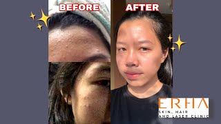 REVIEW HASIL PEMAKAIAN ERHA | 2 MINGGU JERAWAT, FUNGAL ACNE TUNTAS😍