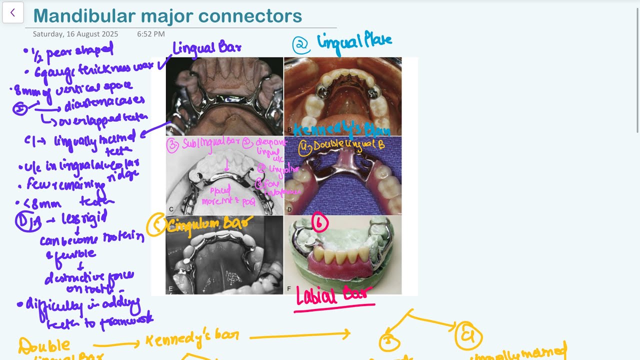 Mandibular Major Connectors RPD Prosthodontics - YouTube
