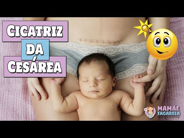 Cicatriz da cesárea: como cuidar? - BabyHome