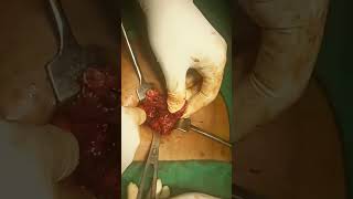 Complicated Appendicitis