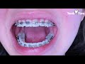 Braces Checkups - 1 year progress - Tooth Time Family Dentistry New Braunfels