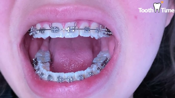 My Last Braces Checkup - Bending orthodontic wire - Tooth Time