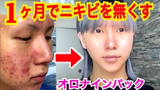 【実録】たった１ヶ月で、4年間治らなかったニキビを全滅させた僕の【毎日スキンケア】