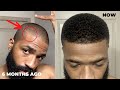 How to derma roll for thinning hairline and corners