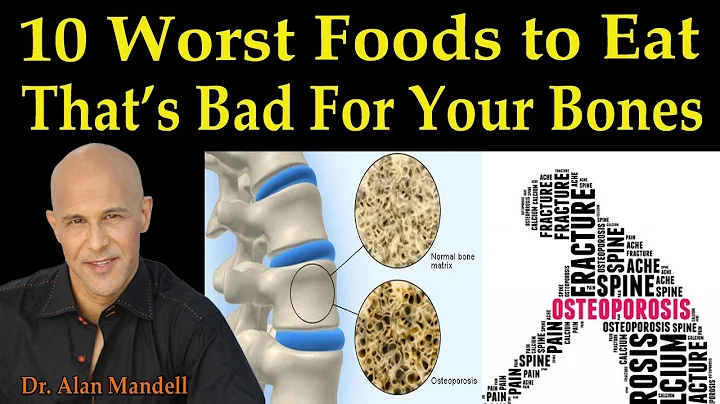 10 Worst Foods to Eat That's Bad for Your Bones (Osteoporosis) - Dr. Alan Mandell, D.C.
