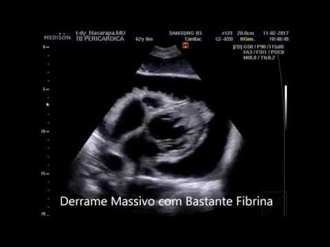 Vídeo: Implante De Stent Micro-bypass Trabecular De Segunda Geração: Análise Retrospectiva Após 12 E 24 Meses De Acompanhamento