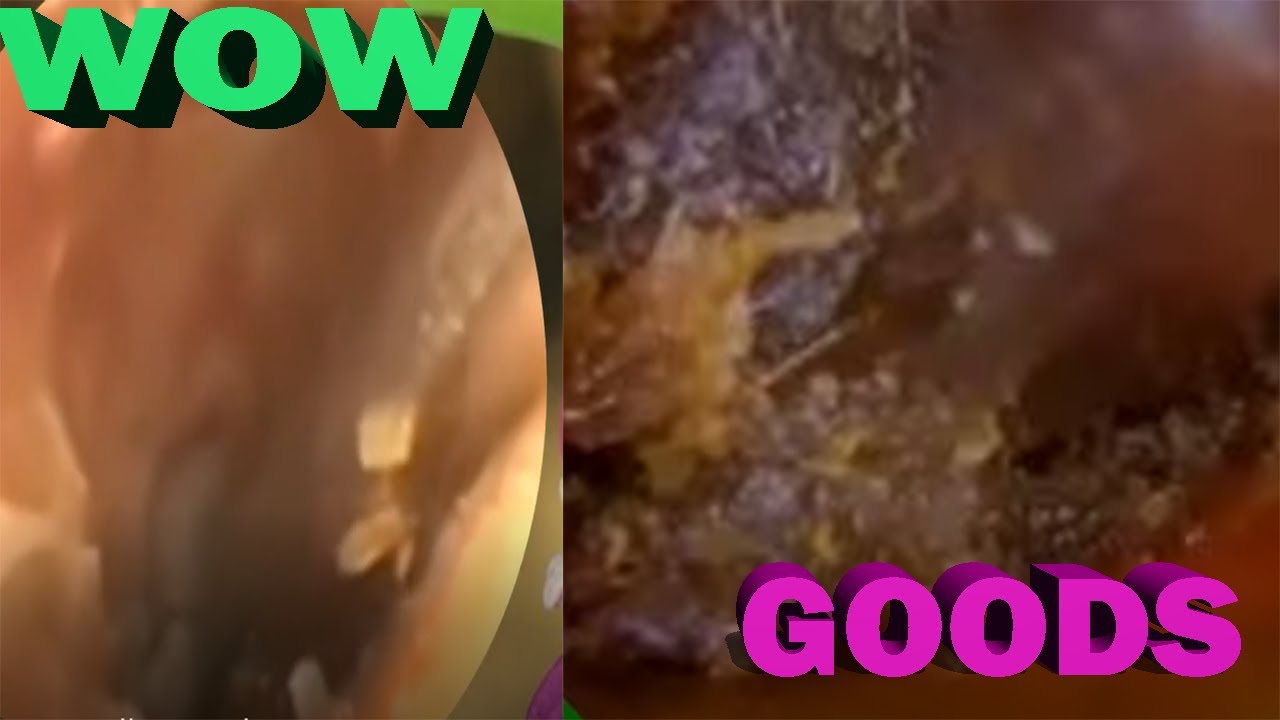 Ear Wax. Deep Impacted Hard Stuck Ear Wax Removal& Cleaning Sap61