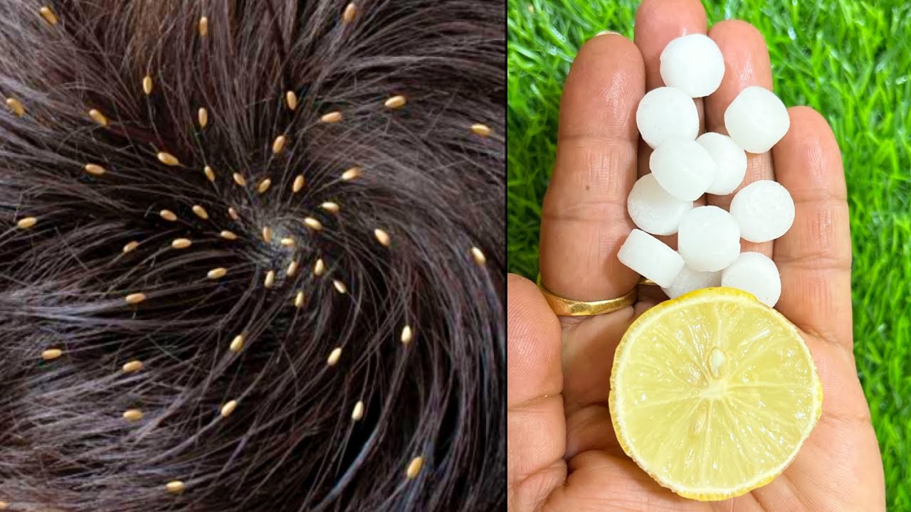 सर की जूँ 1 बार के इस्तेमाल से ख़त्म / Lice Removal at Home जुओं का ख़ात्मा Get rif of Lice