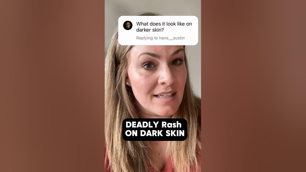 meningitis-rash-on-dark-skin-tones-what-it-looks-like-youtube