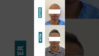 Worried about baldness? Meet Dr Sreekar Harinatha for the latest FUE HT in Bangalore today!