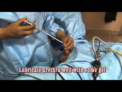 Download Bipolar turp 4 How to dilate the urethra and insert the resectoscope sheath