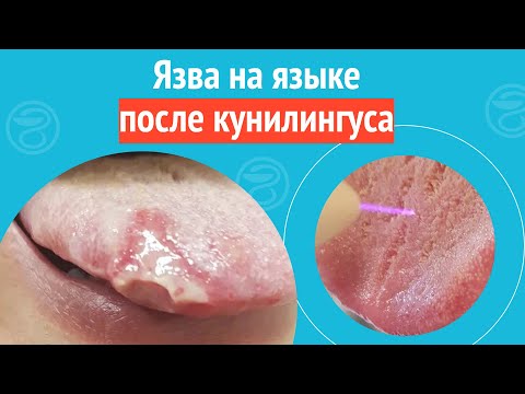 👅 Язва на языке после кунилингуса. Клинический случай №1235