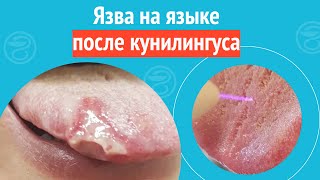 👅 Язва На Языке После Кунилингуса. Клинический Случай №1235