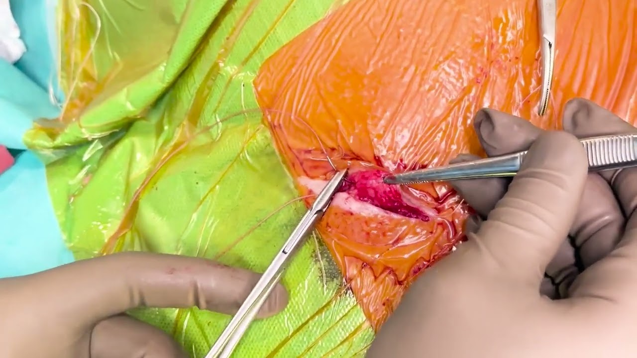 Generator change of dual chamber pacemaker