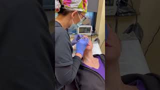 Rhinoplasty Cast Removal
