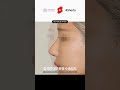 휴먼성형외과 코재수술 #shorts