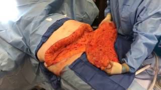 Panniculectomy: Removal of excess skin in the abdomen