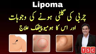 Homeopathic medicine for lipoma | charbi ki ganth ka ilaz |  How to cure LIPOMA Naturally screenshot 1