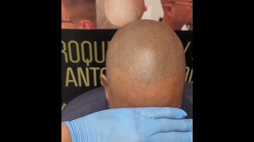 INCREDIBLE TRANSFORMATION WITH SCALP MICROPIGMENTATION  BY ANTONIO BAROQUE
