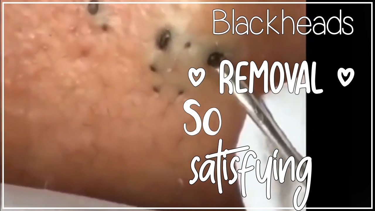 Blackheads removal... So satisfying YouTube