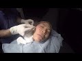 Silhouette InstaLift NYC | Facial Sagging & Jawline Definition with Dr. Bryan Forley