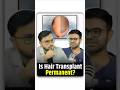 Is Hair Transplant Really Permanent 😳 Doctor Explains Truth!