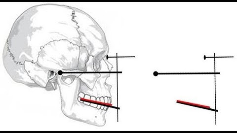 Orientation jaw relation made easy. Why we record orientation jaw relation?What is facebow ?