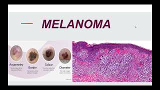 Malignant Melanoma: Pathogenesis, Morphology and Clinical picture.