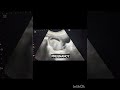 Pregnancy Ultrasound showing blighted ovum! Anembryonic Pregnancy!#ultrasoundmadeeasy86#viralshorts
