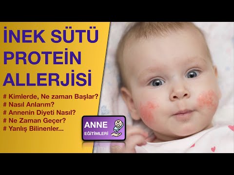 Video: Bebeğinizin Süt Alerjisi Var mı? Bebek Sağlığı A-Z