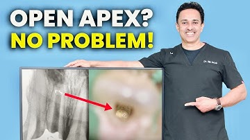 Apexification Made Easy | Step-by-Step Clinical Technique