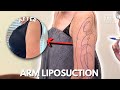 Korean Arm Liposuction Transformation ✨ | Full Surgery + Aftercare Experience | Seoul Guide Medical