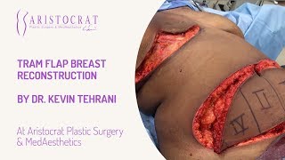 TRAM Flap Breast Reconstruction Long Island, New York by Dr. Kevin Tehrani