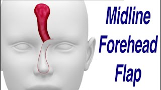 Midline Forehead Flap for Nasal Defect Reconstruction