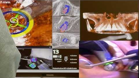 X-Nav Guided Dental Implant Surgery