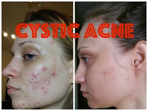 Cystic Acne - How I got rid of it!