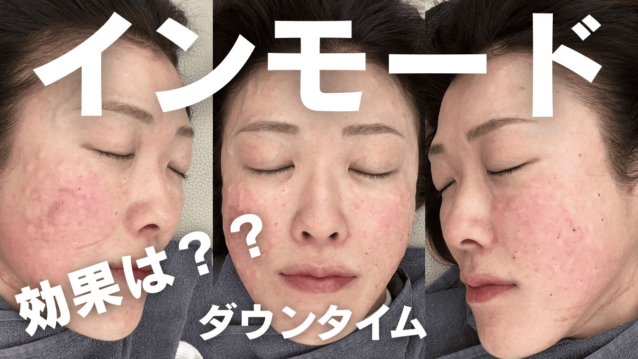 【PRでも正直に・・】アラフォーにインモード・チタニウムリフティング・サーマジェンのどれが効果がよかった？