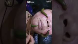 WOMAN TREATED WITH LEECHES TO REMOVE FACIAL PIMPLES by OluwaPlenty A 14,083 views 6 years ago 1 minute, 31 seconds