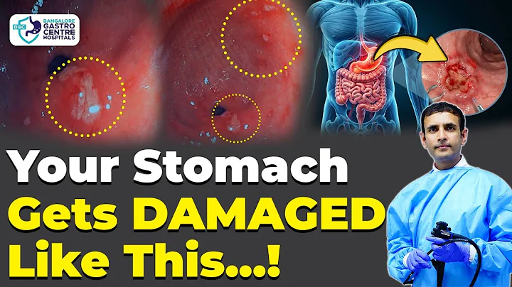 Stomach Ulcer Endoscopy | Real Inside View of Gastric Ulcer Explained | Causes, Symptoms & Treatment