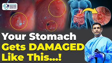 Stomach Ulcer Endoscopy | Real Inside View of Gastric Ulcer Explained | Causes, Symptoms & Treatment