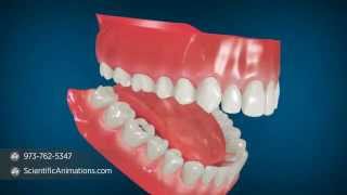 Dental Air Abrasion | Dental Animation