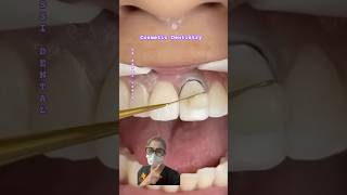 SMILE Composite Veneers not expensive