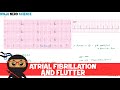 Rate and Rhythm | Atrial Fibrillation and Atrial Flutter