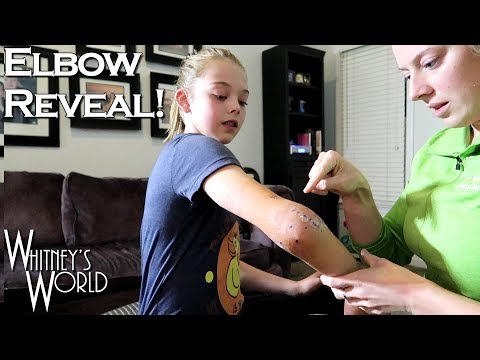 Taking Off the Bandage! | Elbow Surgery | Whitney Bjerken
