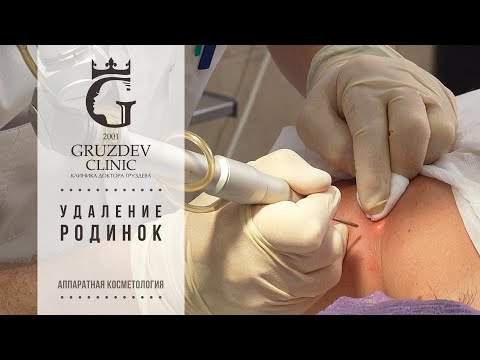 Удаление родинок