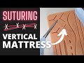 Mastering The Vertical Mattress Suture | OnlineExodontia.com