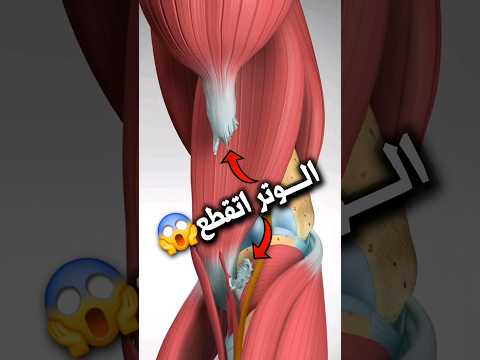 تمزق وتر عضلة الباي 
