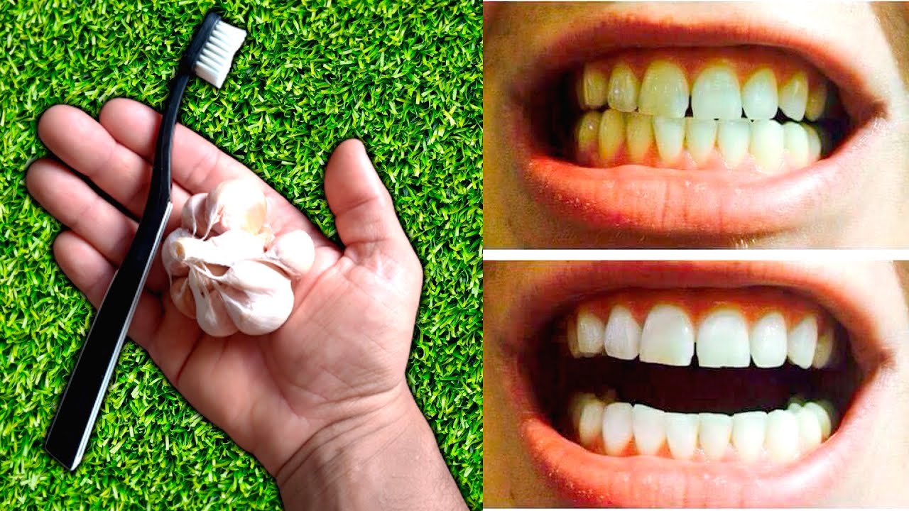 COMO CLAREAR OS DENTES EM MINUTOS CLAREAR OS DENTES EM UM DIA Teeth Whitening At Home In 2 COMO CLAREAR OS DENTES EM MINUTOS CLAREAR OS DENTES EM UM DIA Teeth Whitening At Home In 2